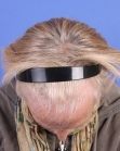 Before Hair Transplant&nbsp;Hair Thinning